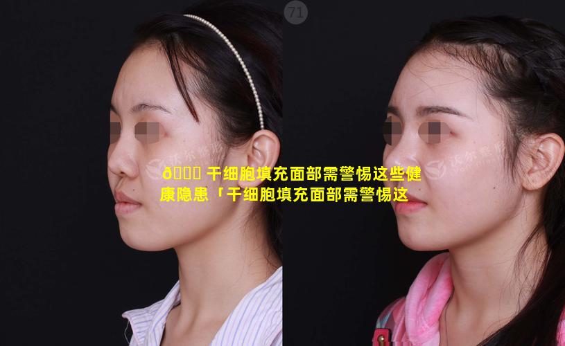 🐟 干细胞填充面部需警惕这些健康隐患「干细胞填充面部需警惕这些健康隐患 🌸 吗」